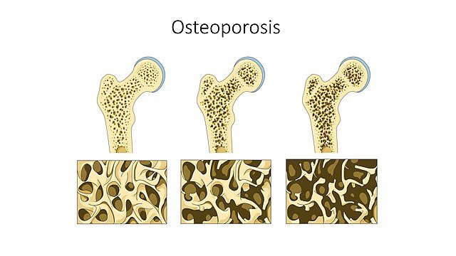 Brown Fat and Bone Health: The Surprising Connection You Need to Know - Hyperwear